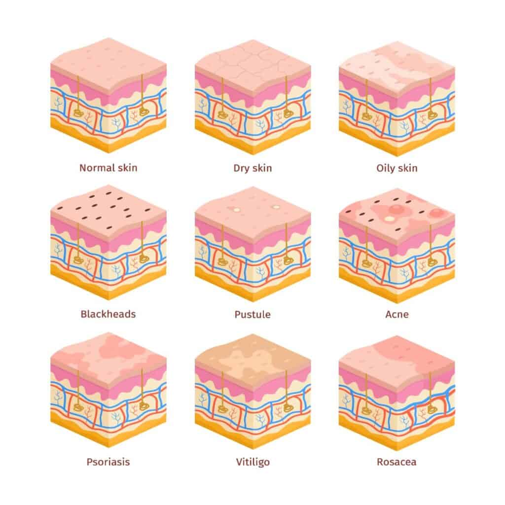 natural soap for acne, skin types diagram
